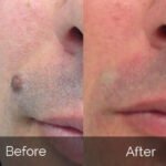 DermaRX Skin Tag Remover-real-reviews